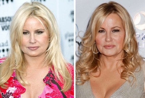 jennifer-coolidge-plastic-surgery-before-and-after-01-e1421337403883